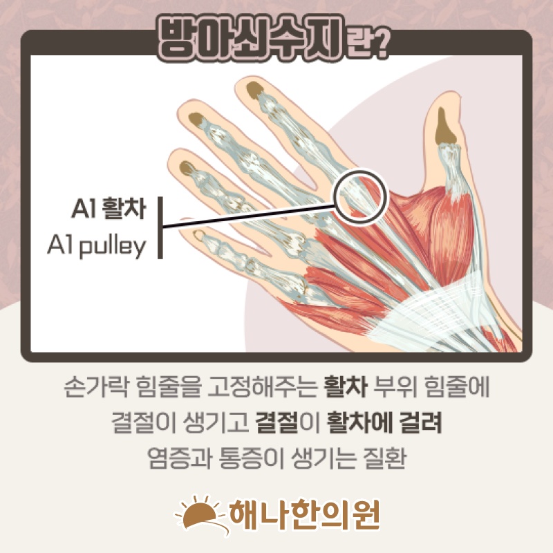 손가락을 움직일 때 딸깍거리고 아픈 방아쇠수지 증상