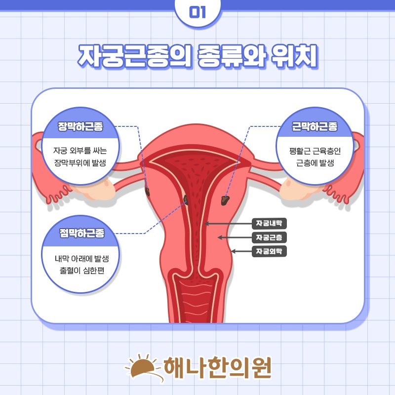 폐경 후 출혈이 지속될 때 자궁근종과의 연관성